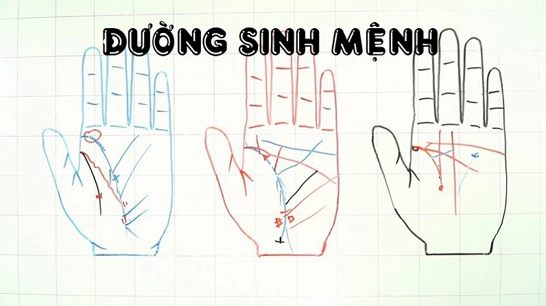 Đường chỉ tay sinh mệnh có thể bị ảnh hưởng bởi yếu tố di truyền