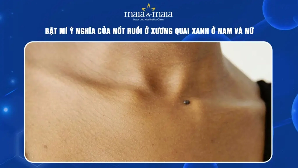 Nốt ruồi ở xương quai xanh