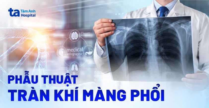 Phẫu thuật tràn khí màng phổi cần chuẩn bị và lưu ý gì khi mổ?
