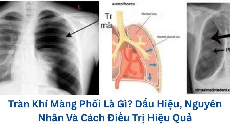 tran-khi-mang-phoi-la-gi