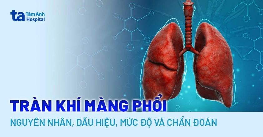 Tràn khí màng phổi là gì