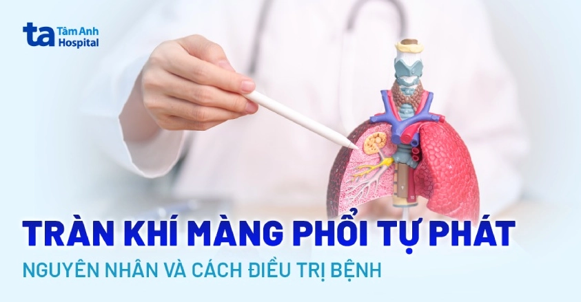 Tràn khí màng phổi tự phát: Nguyên nhân và cách điều trị bệnh