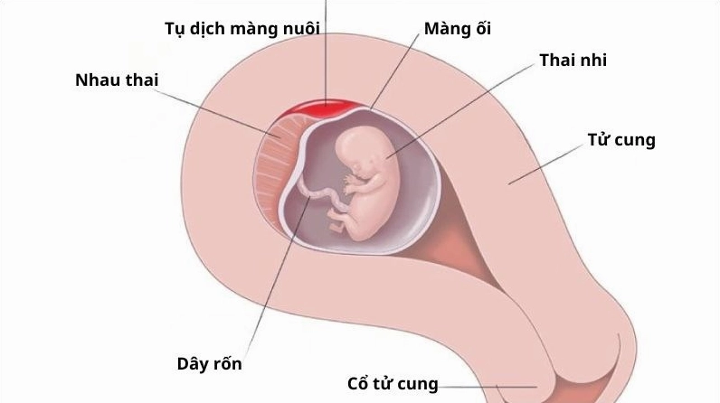 Tụ dịch màng nuôi là tình trạng có khối máu tụ ở giữa tử cung và túi ối